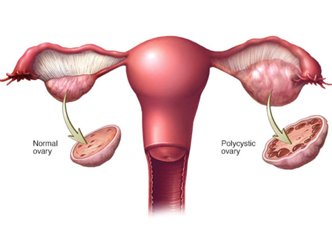 PCOS-overview